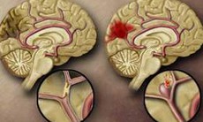 Hội chứng lỗ khuyết não